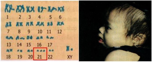 bệnh đao bệnh đao