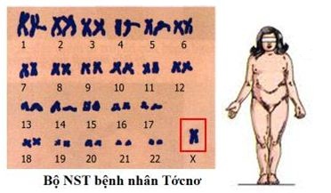 bệnh tocno bệnh tocno