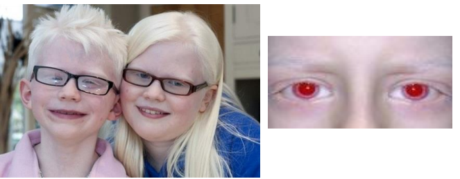 bệnh bạch tạng bệnh bạch tạng