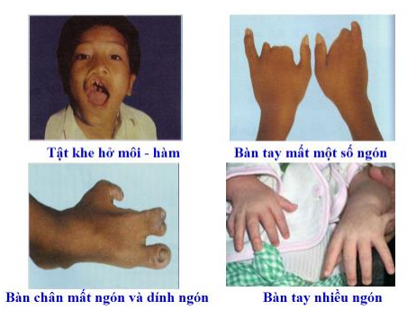 tật di truyền tật di truyền